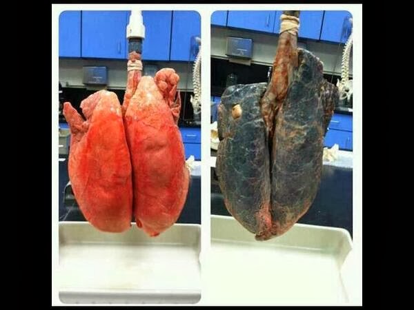 Busca les diferències entre els pulmonses diferències: pulmons de no fumador vs pulmons de fumador